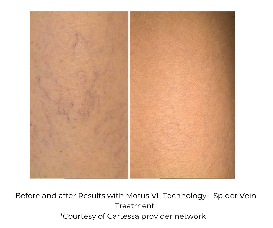 Vein treatment results using Motus AZ VL function