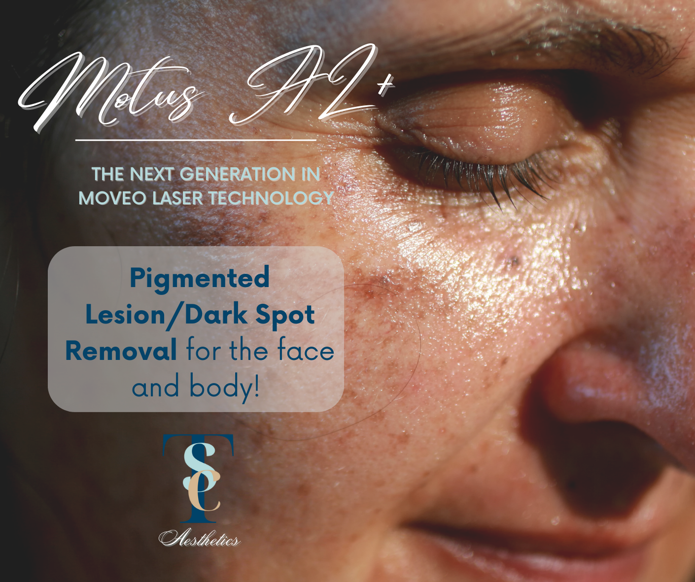 TSC Aesthetics Dark Spot Removal with Motus AZ +